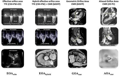 Aliased Flow Signal Planimetry by Cardiovascular Magnetic Resonance Imaging for Grading Aortic Stenosis Severity: A Prospective Pilot Study